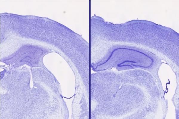 آلزایمر آلزایمر,کمک 40 درصدی یک داروی خواب به مقابله با آلزایمر