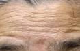 چین و چروک,کشف سازوکار چروک شدن پوست با افزایش سن