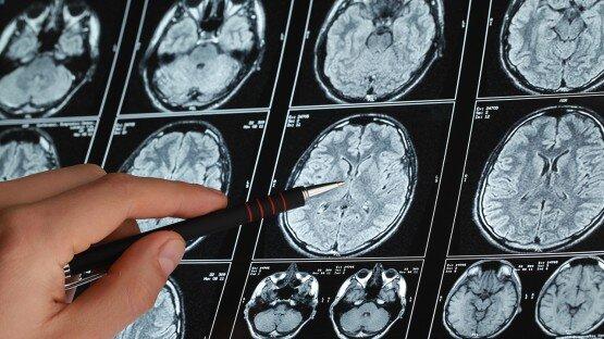آلزایمر,تشخیص زودهنگام آلزایمر با اسکن مغزی جدید