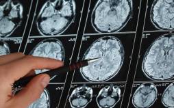 آلزایمر,تشخیص زودهنگام آلزایمر با اسکن مغزی جدید