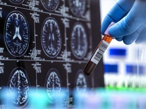 آلزایمر,تشخیص بیماری آلزایمر با کمک هوش مصنوعی