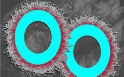 تومورهای تخمدان,نابودی بیش از ۸۰ درصدی تومورهای تخمدان با نانوذرات جدید