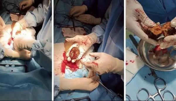 خرمالو خرمالو,ماجرای خرمالو در اتاقهای عمل مشهد