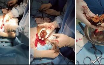 خرمالو,ماجرای خرمالو در اتاق‌های عمل مشهد