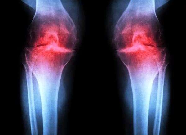 آرتروز,درمان آرتروز