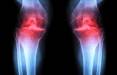 آرتروز,درمان آرتروز