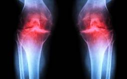 آرتروز,درمان آرتروز