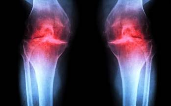 آرتروز,درمان آرتروز