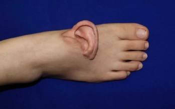 پیوند گوش به پا,گوش