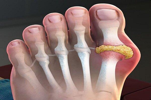 نقرس,کمک داروهای نقرس به سلامت قلب