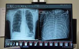 مردی ۴۸ ساعت بدون ریه زنده ماند! ریه,زنده ماندن فردی ۴۸ ساعت بدون ریه