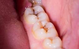 پوسیدگی دندان,کشف راز پوسیدگی دندان