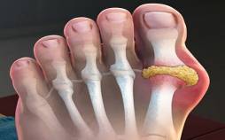 نقرس,کمک داروهای نقرس به سلامت قلب