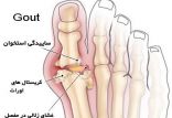 اخبار پزشکی,خبرهای پزشکی,مشاوره پزشکی,بیماری نقرس