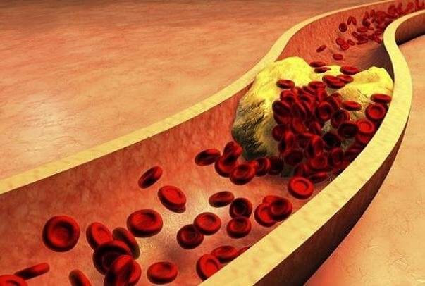 سفت شدگی عروق،تازه های پزشکی،خبرهای پزشکی،اخبار پزشکی اخبار پزشکی,خبرهای پزشکی,تازه های پزشکی,سفت شدگی عروق