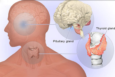 بیماری تیروئید, هیپرتیروئیدیسم،مشاوره پزشکی،خبرهای پزشکی،اخبار پزشکی اخبار پزشکی,خبرهای پزشکی,مشاوره پزشکی,بیماری تیروئید, هیپرتیروئیدیسم