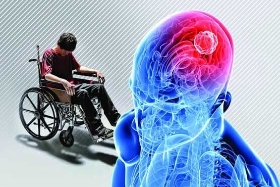 اخبار پزشکی,خبرهای پزشکی,مشاوره پزشکی,نشانه های ابتلا به ام اس