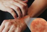 اخبار پزشکی,خبرهای پزشکی,تازه های پزشکی,كهير