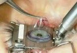 اخبار پزشکی,خبرهای پزشکی,مشاوره پزشکی,لازک