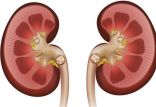 اخبار پزشکی,خبرهای پزشکی,مشاوره پزشکی,سنگ کلیه
