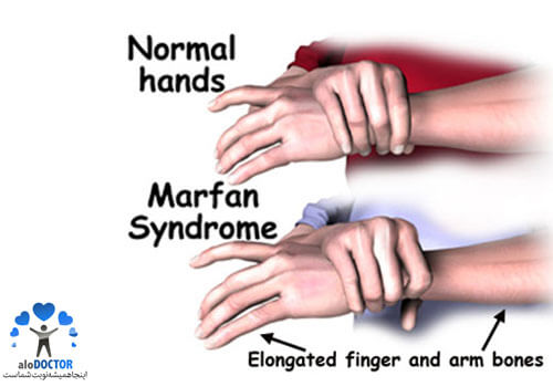 اخبار پزشکی,خبرهای پزشکی,مشاوره پزشکی,سندرم مارفان