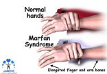 اخبار پزشکی,خبرهای پزشکی,مشاوره پزشکی,سندرم مارفان