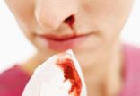 اخبار پزشکی,خبرهای پزشکی,تازه های پزشکی,خون دماغ شدن