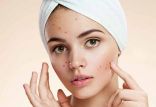 اخبار پزشکی,خبرهای پزشکی,مشاوره پزشکی,آکنه