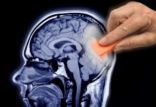اخبار پزشکی,خبرهای پزشکی,تازه های پزشکی,تشنج نهفته