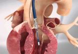 اخبار پزشکی,خبرهای پزشکی,تازه های پزشکی,قلب