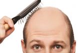 اخبار پزشکی,خبرهای پزشکی,تازه های پزشکی,طاسی سر