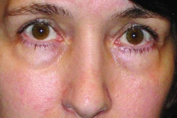 بوتاکس،مشاوره پزشکی،خبرهای پزشکی،اخبار پزشکی اخبار پزشکی,خبرهای پزشکی,مشاوره پزشکی,بوتاکس