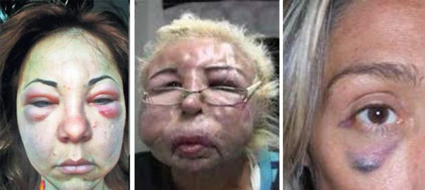 بوتاکس،مشاوره پزشکی،خبرهای پزشکی،اخبار پزشکی اخبار پزشکی,خبرهای پزشکی,مشاوره پزشکی,بوتاکس