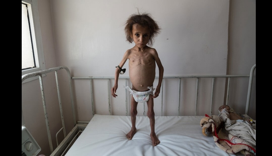 تصاویر وضعیت مردم یمن,تصاویر وضعیت مردم یمن, وضعیت مردم یمن در حملات سعودی ها