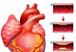 تنگی رگ‌ های قلب,اخبار پزشکی,خبرهای پزشکی,مشاوره پزشکی