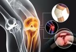 بیماری آرتروز,اخبار پزشکی,خبرهای پزشکی,مشاوره پزشکی