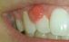 آبسه دندان