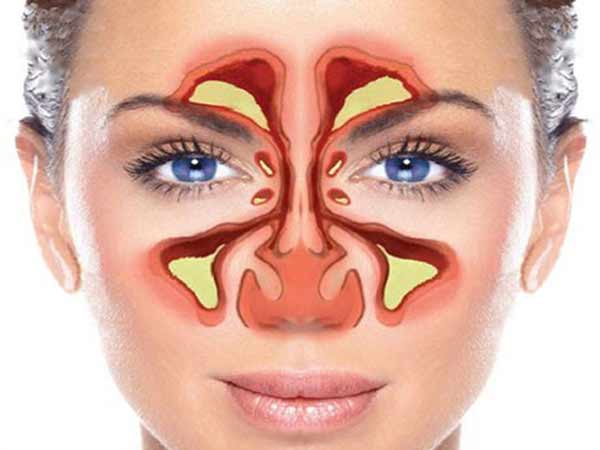سینوزیت,اخبار پزشکی,خبرهای پزشکی,تازه های پزشکی