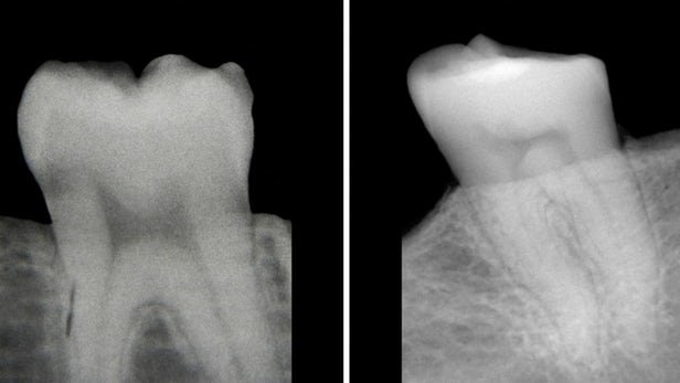 عکس رادیولوژی دندان,اخبار پزشکی,خبرهای پزشکی,تازه های پزشکی