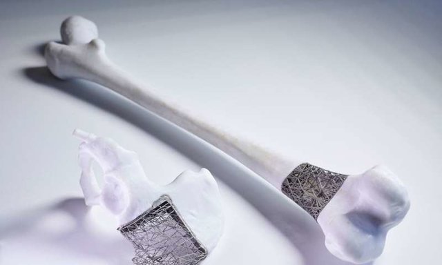 سرطان استخوان,اخبار پزشکی,خبرهای پزشکی,تازه های پزشکی