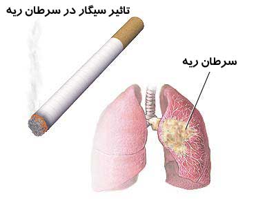 سرطان ریه سرطان ریه,اخبار پزشکی,خبرهای پزشکی,تازه های پزشکی