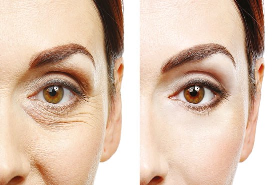 جراحی بلفاروپلاستی,اخبار پزشکی,خبرهای پزشکی,مشاوره پزشکی