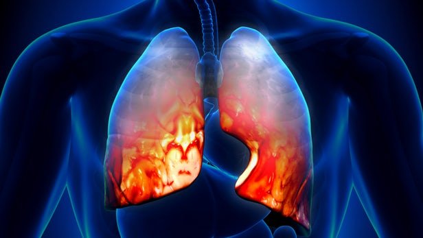 بیماری پنومونی,اخبار پزشکی,خبرهای پزشکی,تازه های پزشکی