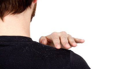 شوره سر شوره سر,اخبار پزشکی,خبرهای پزشکی,مشاوره پزشکی