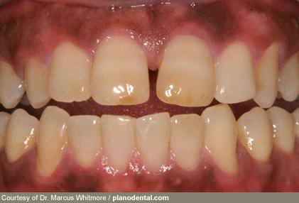 دندان دندان,اخبار پزشکی,خبرهای پزشکی,مشاوره پزشکی