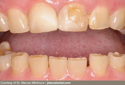 دندان دندان,اخبار پزشکی,خبرهای پزشکی,مشاوره پزشکی