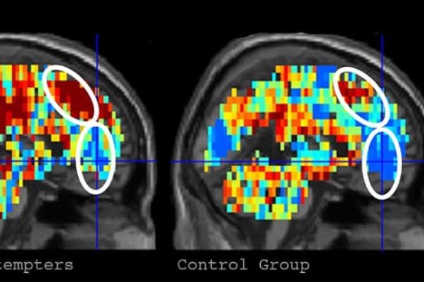 اسکن مغزی,اخبار پزشکی,خبرهای پزشکی,تازه های پزشکی