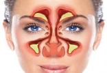 سینوزیت,اخبار پزشکی,خبرهای پزشکی,تازه های پزشکی
