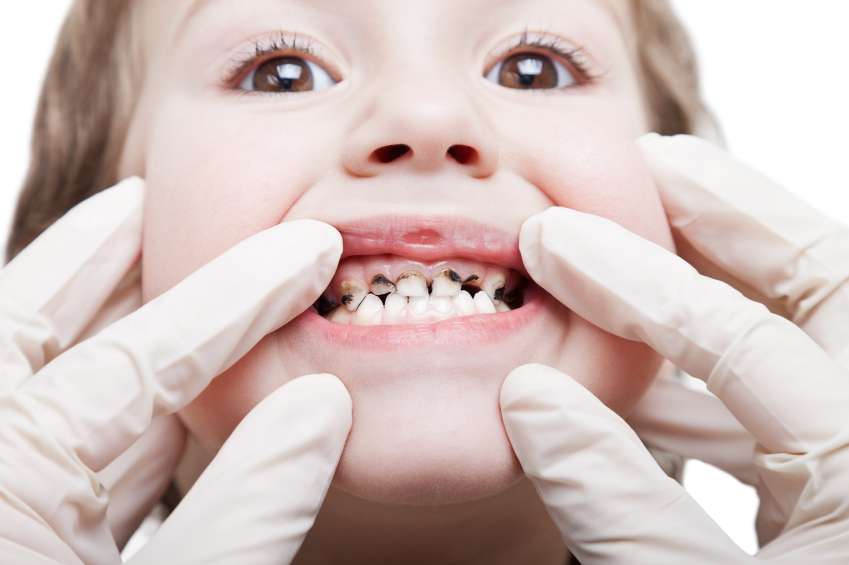 پوسیدگی دندان کودک,اخبار پزشکی,خبرهای پزشکی,مشاوره پزشکی