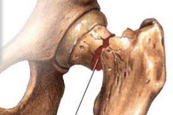 پوکی استخوان پوکی استخوان,اخبار پزشکی,خبرهای پزشکی,مشاوره پزشکی